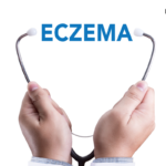 Eczema
