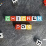Chickenpox Treatment